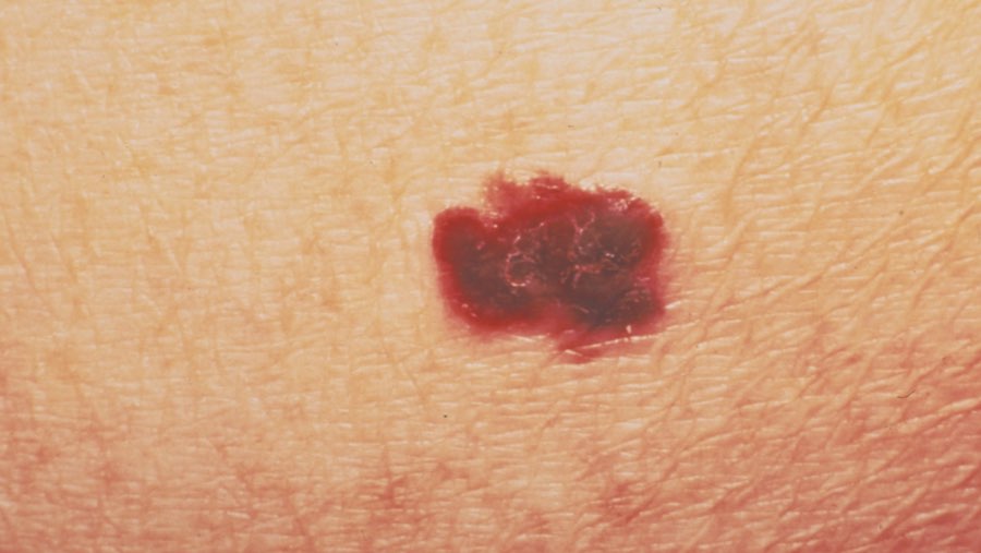 Kanker kulit (Sumber: Bloomberg)