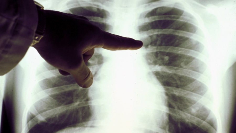 Ilustrasi paru-paru (Sumber: Bloomberg)