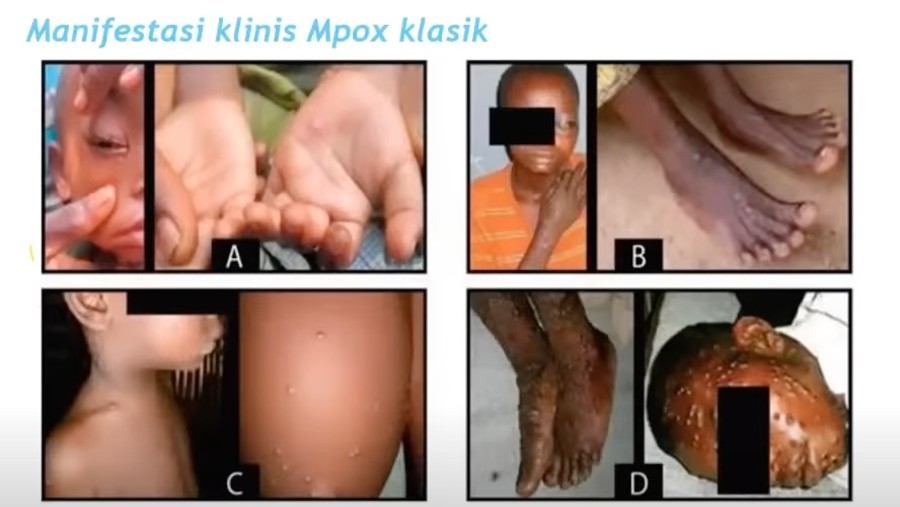 Mpox. (Sumbe: Akun YouTube Sulianto Saroso Hospital)