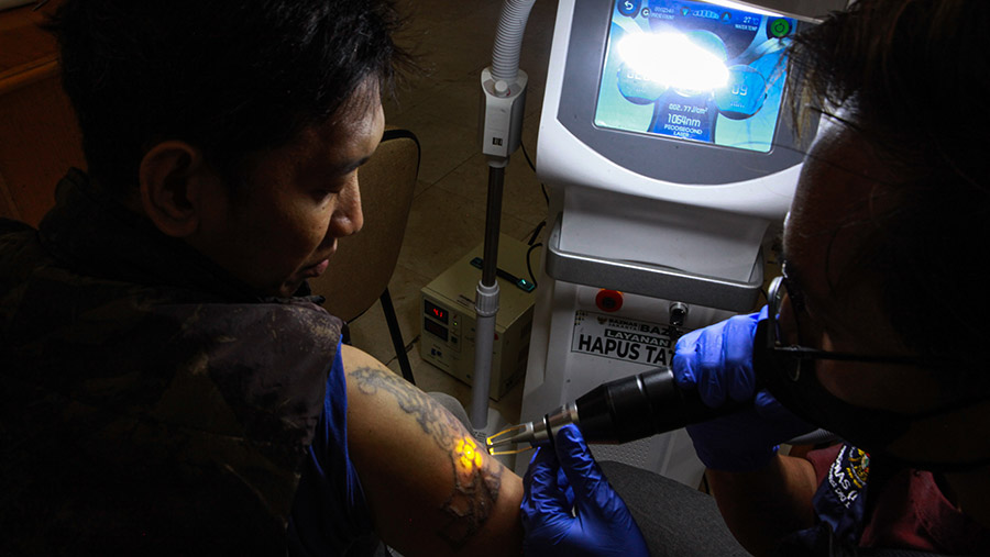 Proses penghapusan tato menggunakan laser yang dilakukan tenaga profesional. (Bloomberg Technoz/Andrean Kristianto)
