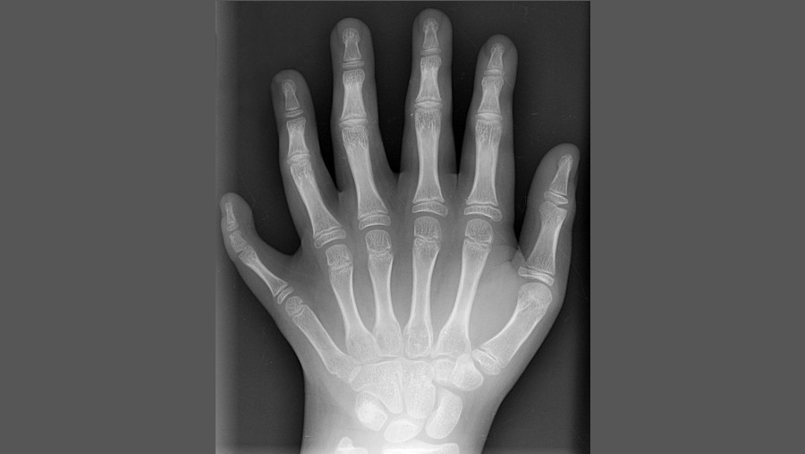 Ilustrasi jumlah lima jari manusia. (Wikipedia)