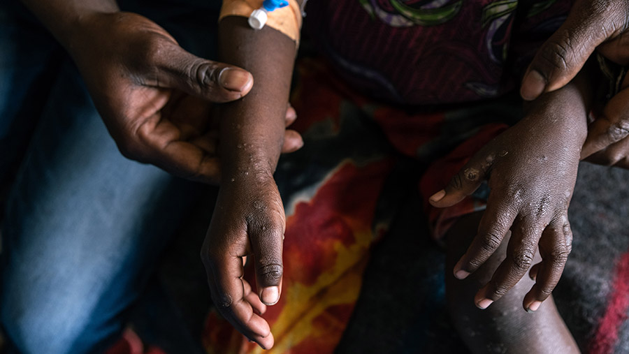 Warga menunjukkan cacar monyet atau Monkeypox (Mpox) pada anaknya di Nyiragongo, Kivu Utara, Kongo, Selasa (20/8/2024). (Arlette Bashizi/Bloomberg)