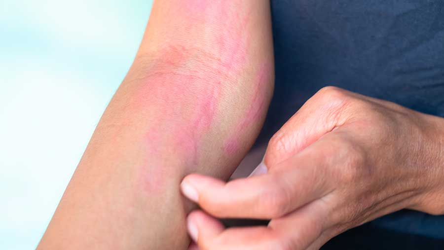 Ilustrasi gatal-gatal (Envato)