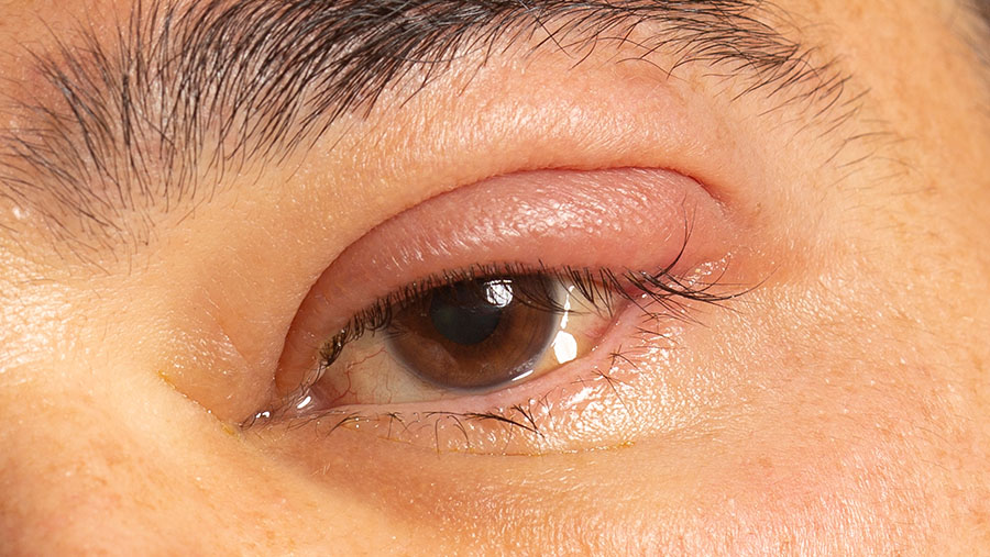 Ilustrasi Mata Bengkak (envato/jgcocinarte)