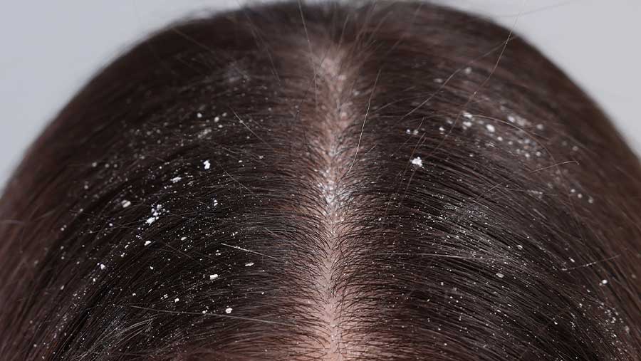 Ilustrasi rambut berketombe (Envato)