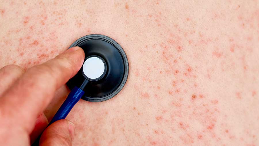 Ilustrasi campak (Envato)