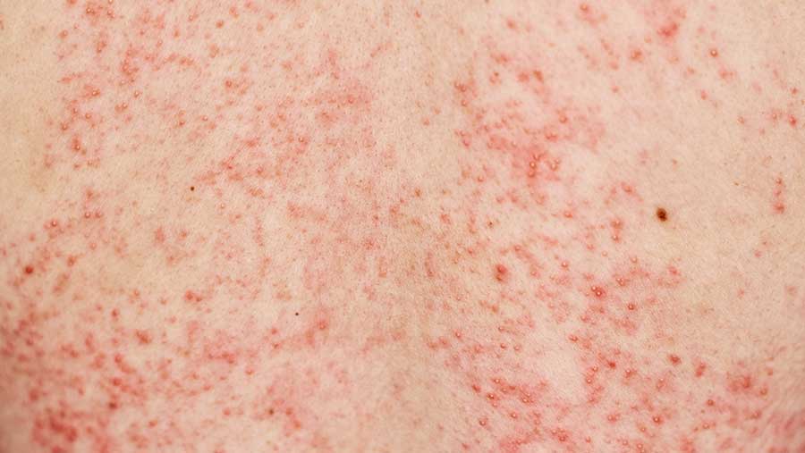 Ilustrasi campak (Envato)